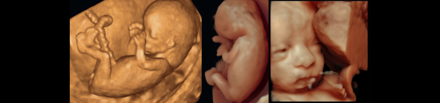Τρισδιάστατο και Τετρασδιάστατο Υπερηχογράφημα Δεσμού Μητέρας και Εμβρύου (3D-4D)